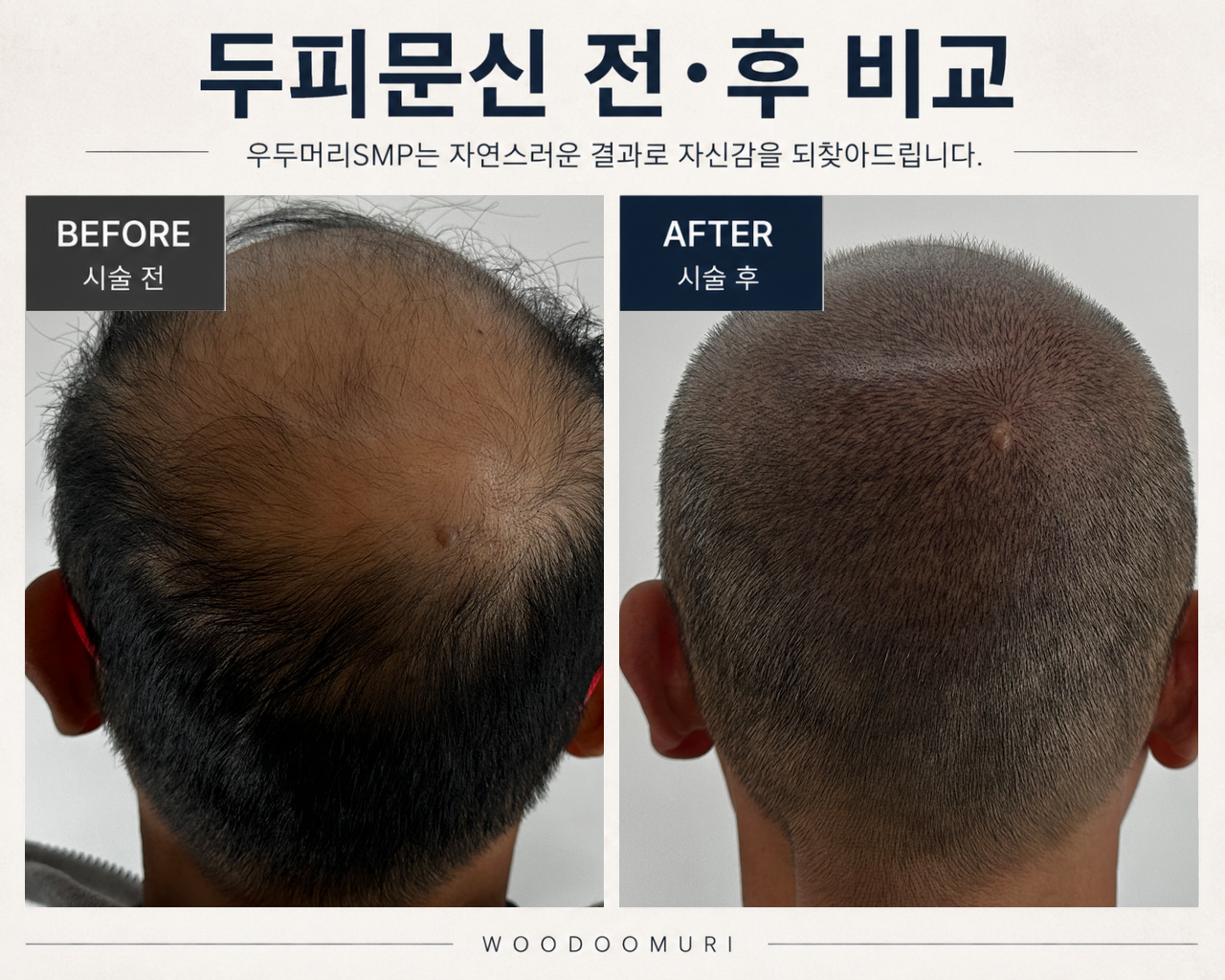 두피문신 전·후 비교 사진. 위쪽이 시술 전, 아래쪽이 시술 후입니다.